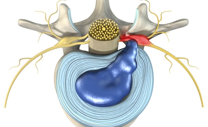 Κήλη μεσοσπονδύλιου δίσκου